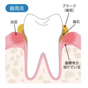 歯周病